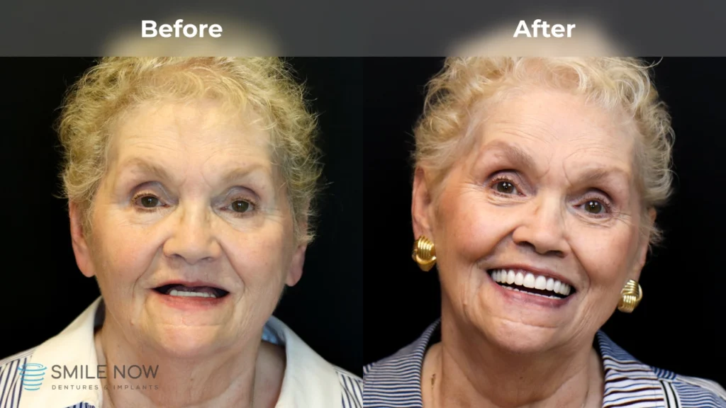 Before and after dental implants in Colorado Springs, CO at Smile Now Colorado Springs Dentures and Implants