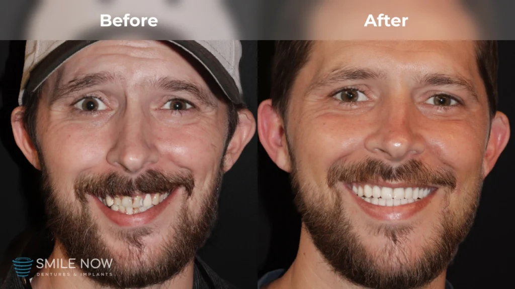 Before and after dental implants in Colorado Springs, CO at Smile Now Colorado Springs Dentures and Implants