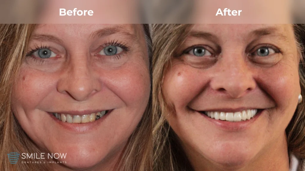 Before and after dental implants in Colorado Springs, CO at Smile Now Colorado Springs Dentures and Implants
