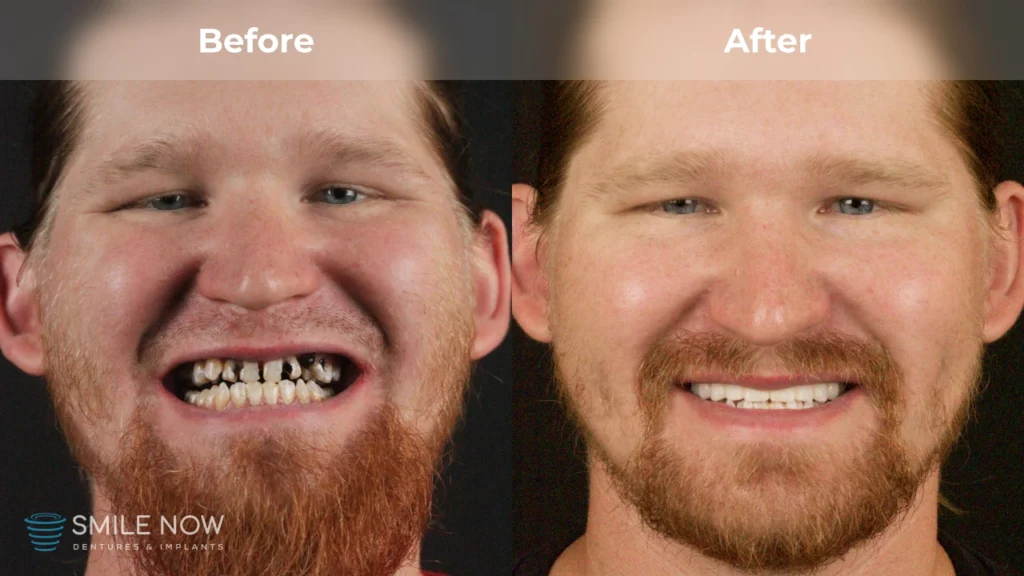Before and after dental implants in Colorado Springs, CO at Smile Now Colorado Springs Dentures and Implants