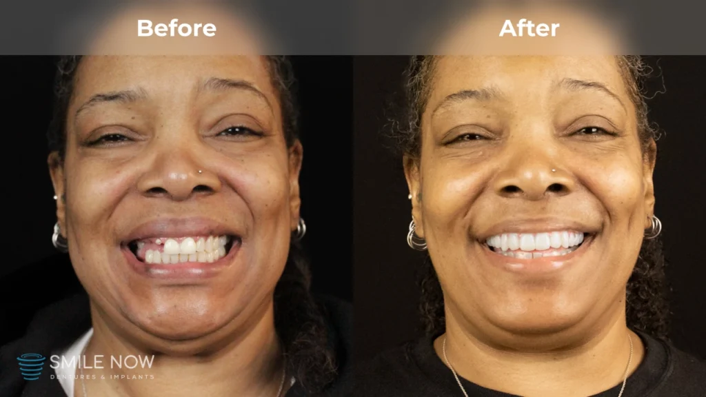 Before and after dental implants in Colorado Springs, CO at Smile Now Colorado Springs Dentures and Implants