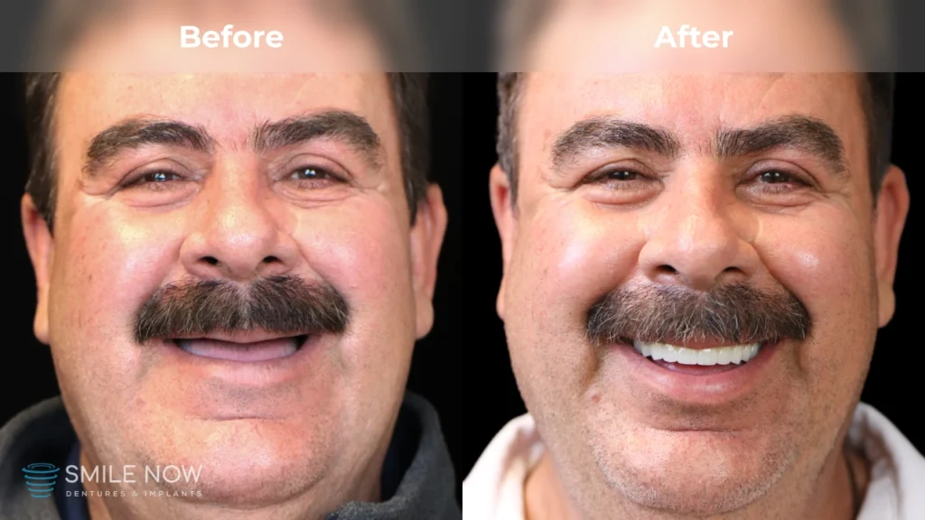 Before and after dental implants in Colorado Springs, CO at Smile Now Colorado Springs Dentures and Implants