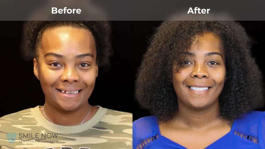 Before and after dental implants in Colorado Springs, CO at Smile Now Colorado Springs Dentures and Implants
