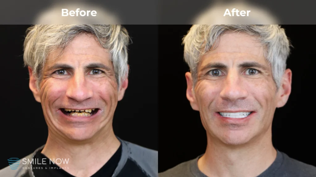 Before and after dental implants in Colorado Springs, CO at Smile Now Colorado Springs Dentures and Implants