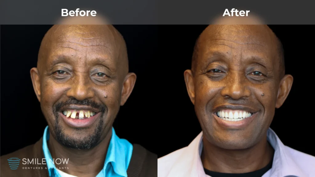 Before and after dental implants in Colorado Springs, CO at Smile Now Colorado Springs Dentures and Implants