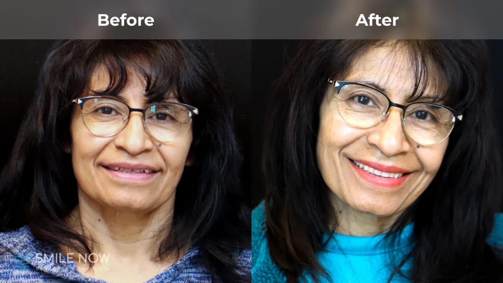 Before and after dental implants in Colorado Springs, CO at Smile Now Colorado Springs Dentures and Implants