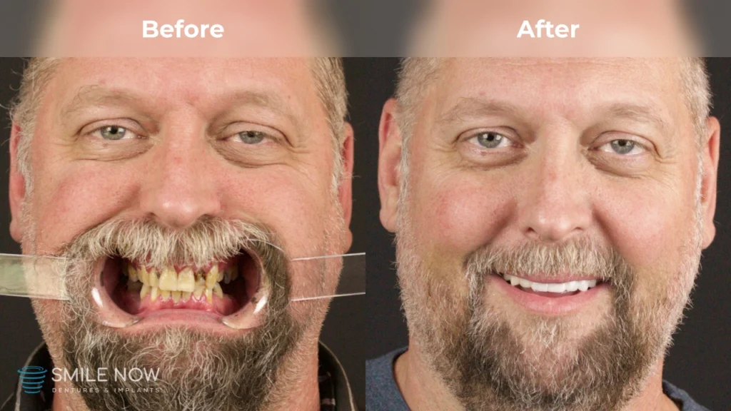Before and after dental implants in Colorado Springs, CO at Smile Now Colorado Springs Dentures and Implants
