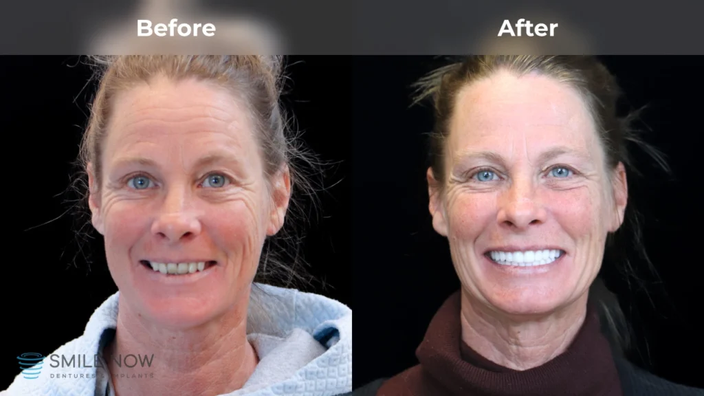 Before and after dental implants in Colorado Springs, CO at Smile Now Colorado Springs Dentures and Implants