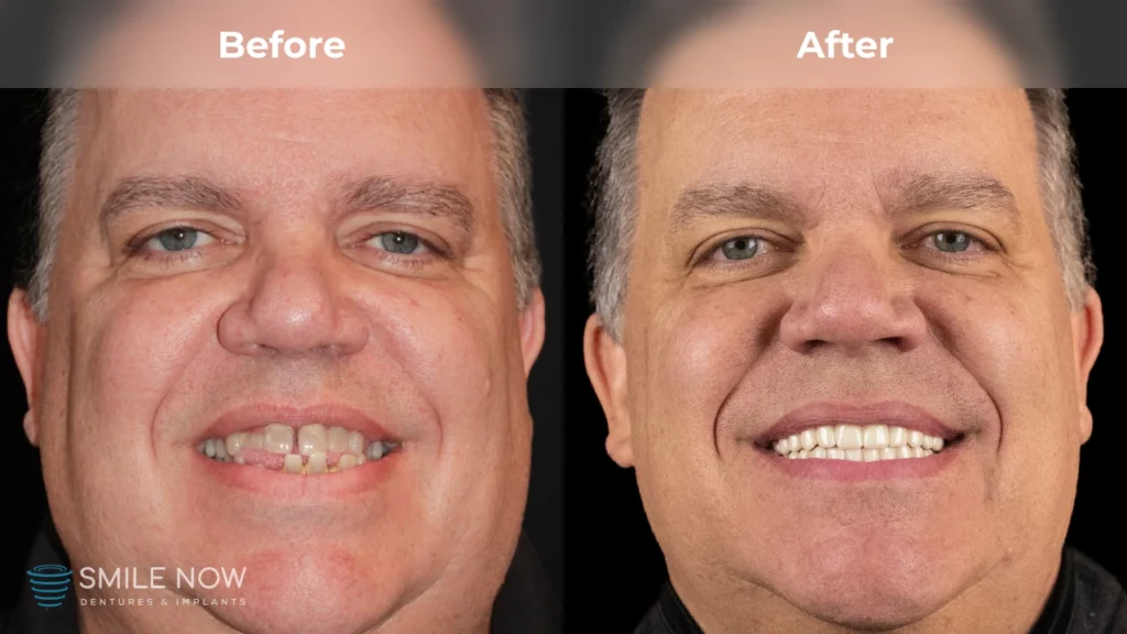 Before and after dental implants in Colorado Springs, CO at Smile Now Colorado Springs Dentures and Implants
