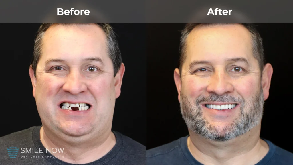 Before and after dental implants in Colorado Springs, CO at Smile Now Colorado Springs Dentures and Implants