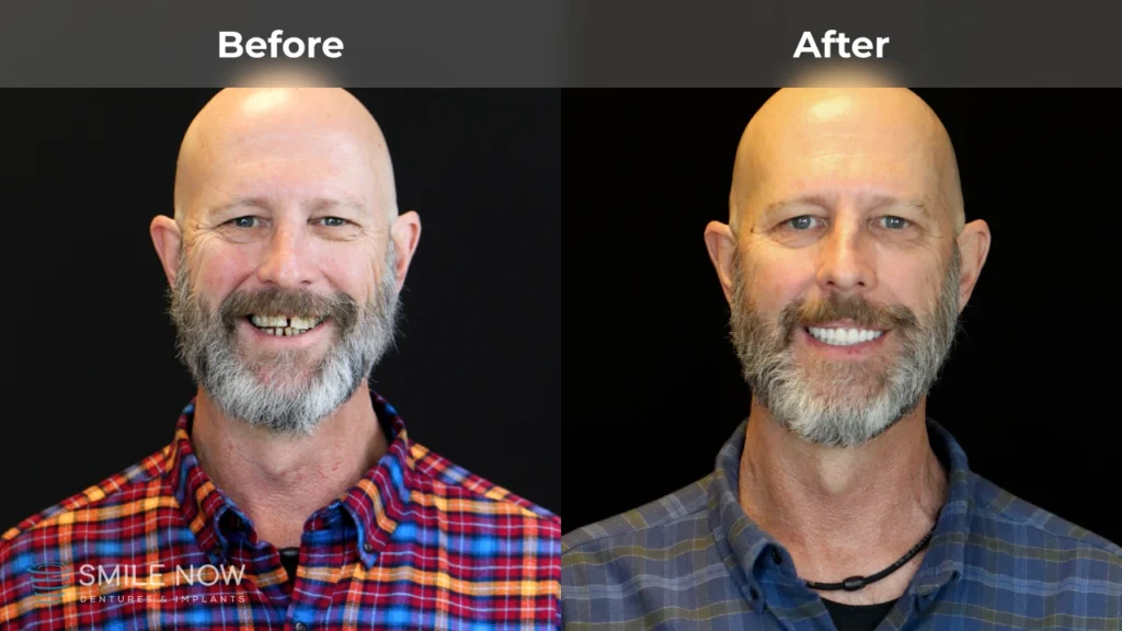 Before and after dental implants in Colorado Springs, CO at Smile Now Colorado Springs Dentures and Implants
