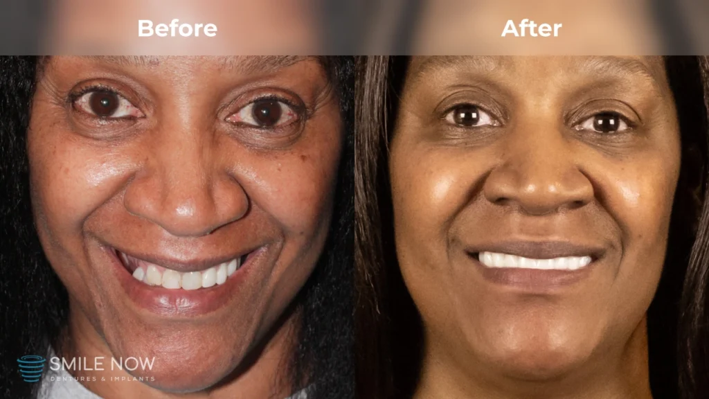 Before and after dental implants in Colorado Springs, CO at Smile Now Colorado Springs Dentures and Implants