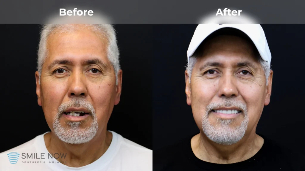Before and after dental implants in Colorado Springs, CO at Smile Now Colorado Springs Dentures and Implants