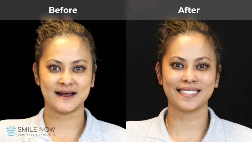 Before and after dental implants in Colorado Springs, CO at Smile Now Colorado Springs Dentures and Implants
