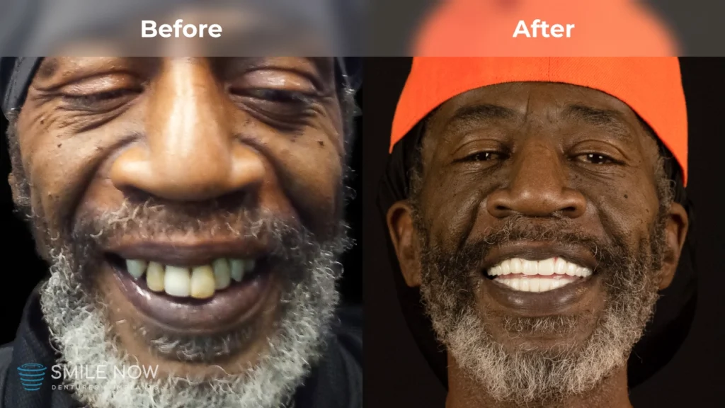 Before and after dental implants in Colorado Springs, CO at Smile Now Colorado Springs Dentures and Implants
