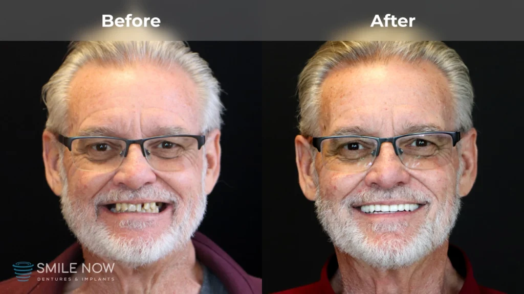 Before and after dental implants in Colorado Springs, CO at Smile Now Colorado Springs Dentures and Implants