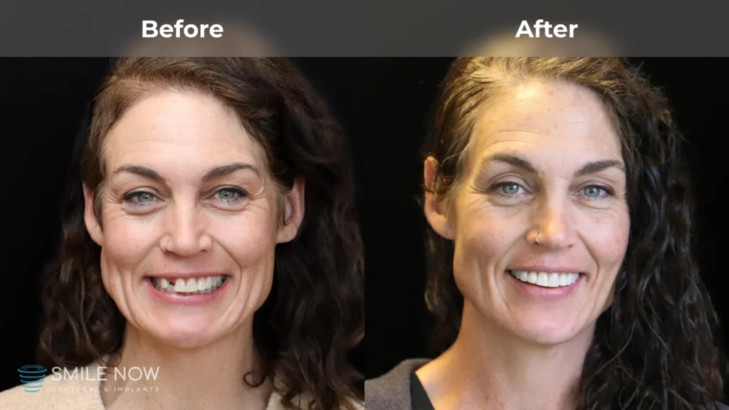 Before and after dental implants in Colorado Springs, CO at Smile Now Colorado Springs Dentures and Implants