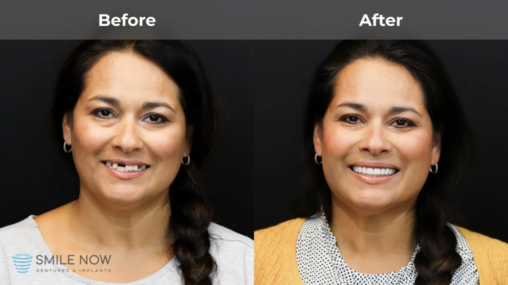 Before and after dental implants in Colorado Springs, CO at Smile Now Colorado Springs Dentures and Implants