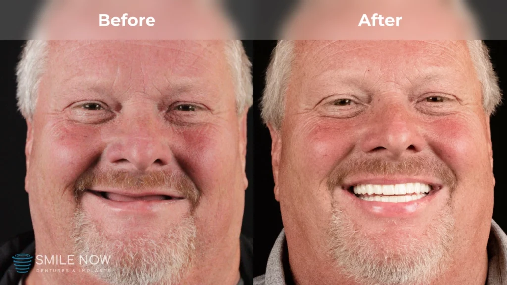 Before and after dental implants in Colorado Springs, CO at Smile Now Colorado Springs Dentures and Implants