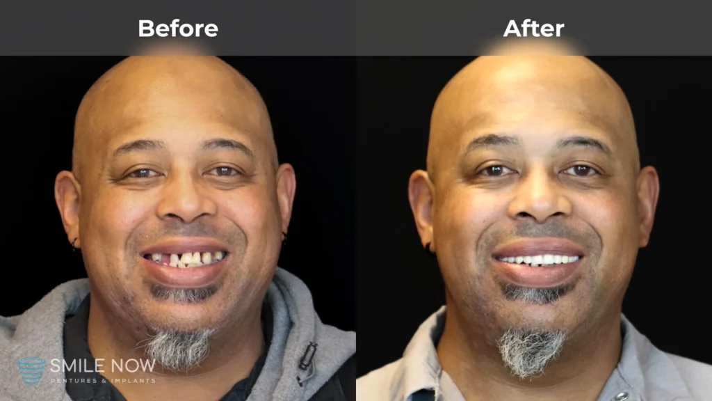 Before and after dental implants in Colorado Springs, CO at Smile Now Colorado Springs Dentures and Implants