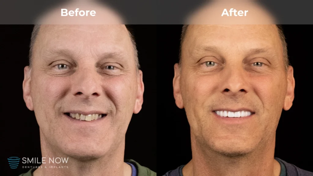 Before and after dental implants in Colorado Springs, CO at Smile Now Colorado Springs Dentures and Implants