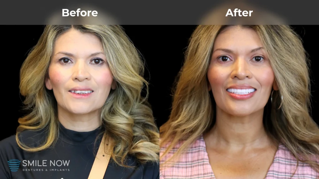 Before and after dental implants in Colorado Springs, CO at Smile Now Colorado Springs Dentures and Implants