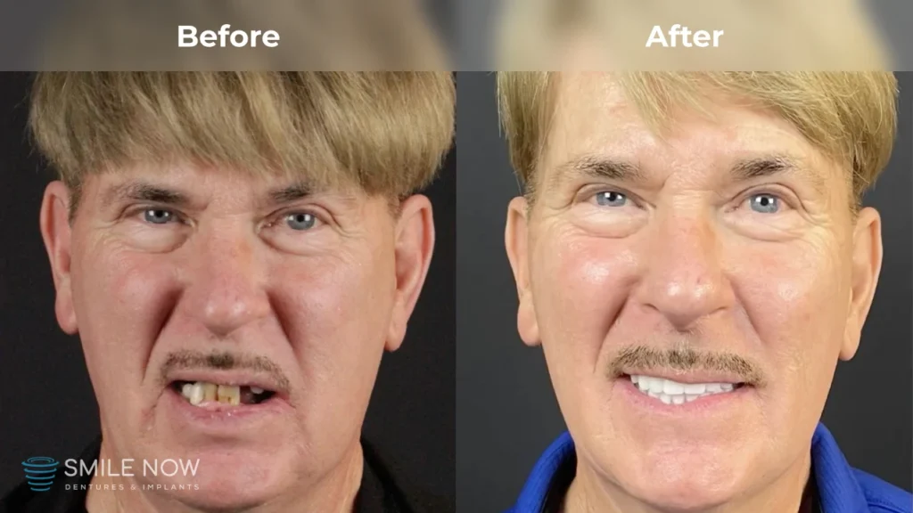 Before and after dental implants in Colorado Springs, CO at Smile Now Colorado Springs Dentures and Implants