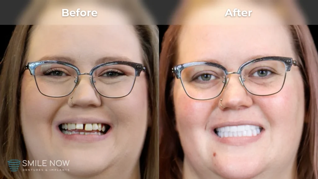 Before and after dental implants in Colorado Springs, CO at Smile Now Colorado Springs Dentures and Implants
