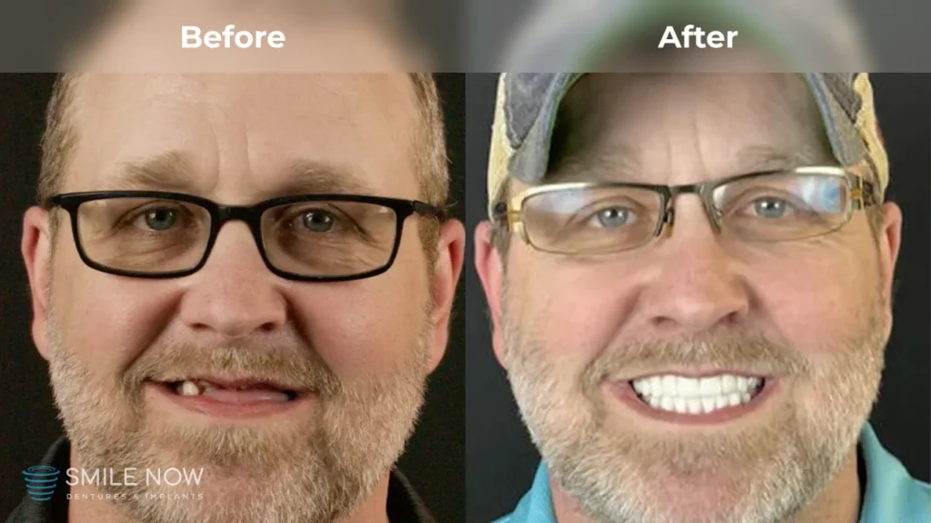 Before and after dental implants in Colorado Springs, CO at Smile Now Colorado Springs Dentures and Implants