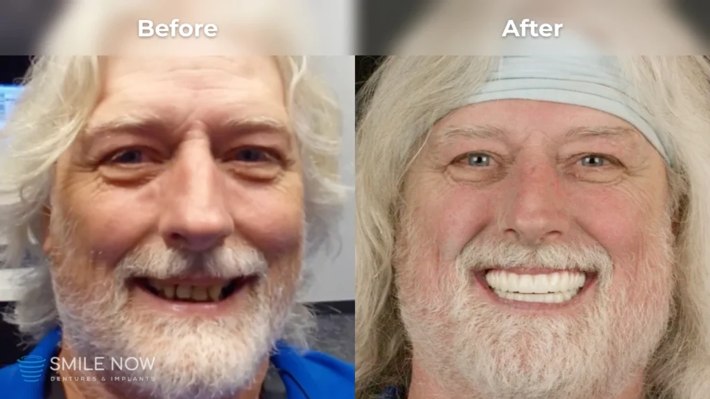 Before and after dental implants in Colorado Springs, CO at Smile Now Colorado Springs Dentures and Implants